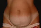 Abdominoplastie ou Plastie abdominale