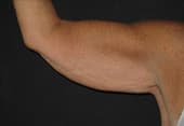 Brachioplastie, lifting ou plastie des bras