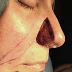 Chirurgie dermatologique