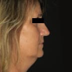 Lifting cervico-facial, lifting temporal