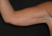 Lipoaspiration des bras