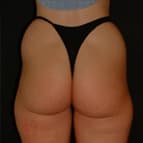 Lipoaspiration, liposuccion, liposculpture