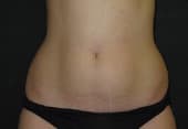 Lipoaspiration abdominale