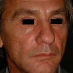 Lipostructure, réinjection de graisse