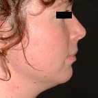 Lipoaspiration sous mentale